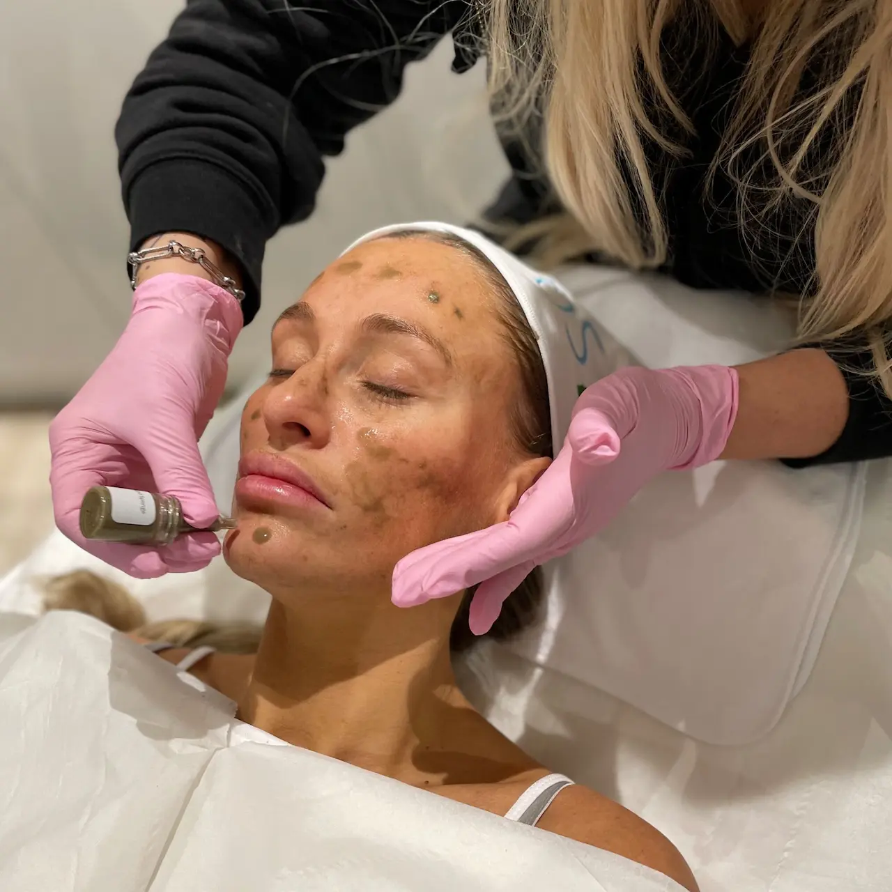 Sqt Bio Microneedling Alchemyclinic Co Uk