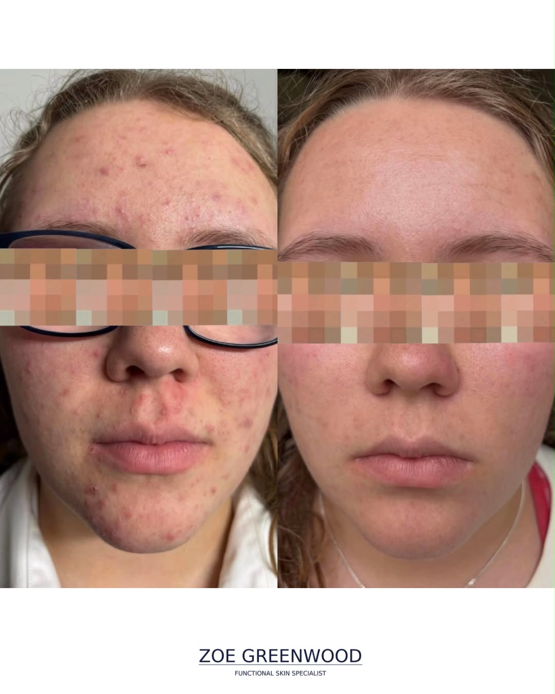 Before and after results from The Healthy Skin Method